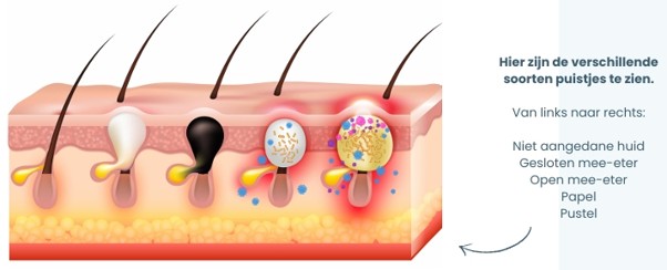 acne diagram